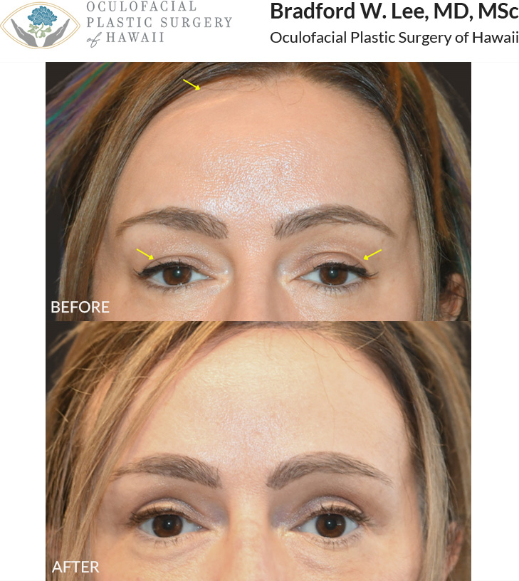This patient in her early 50s was bothered by her high hairline, excess skin on the upper eyelids, and facial aging. She underwent a trichophytic browlift with customized hairline advancement along with an upper blepharoplasty to give her a beautiful and natural enhancement to her eyes, brows, and forehead proportions.