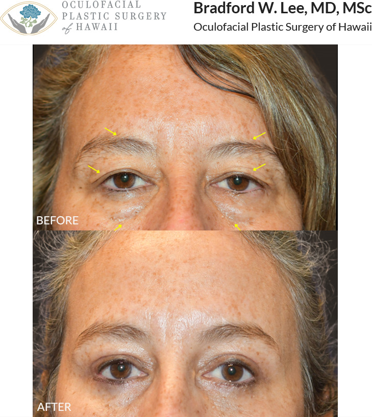 This patient in her early 60s was bothered by the drooping of her upper eyelids, puffiness of her lower eyelids, and asymmetric brow positioning. She underwent a trichophytic brow lift with brow balancing, along with an upper and lower blepharoplasty to lift and symmetrize her brows while giving her eyes a brighter and more refreshed look.