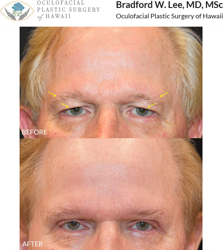 The patient in his 70s was bothered by heaviness of the upper eyelids and brows and wanted a subtle and natural looking enhancement. He underwent an upper blepharoplasty with a direct brow lift to enhance the eyes and brows while still keeping things looking subtle and natural. *After photo taken at post-op month 2 with mild residual swelling.