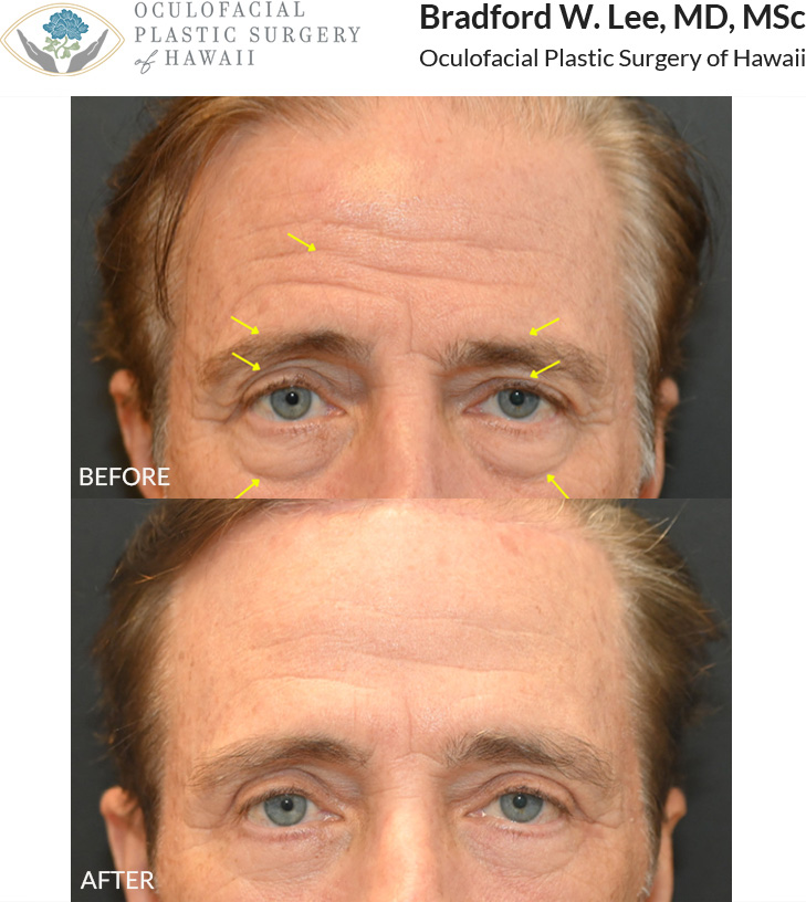 The patient in his 60s was bothered by forehead wrinkling, asymmetric drooping of the brows, and excess skin and fat on the upper and lower eyelids. He underwent a trichophytic brow lift to rejuvenate the forehead region and balance and lift the brows, as well as an upper and lower blepharoplasty to rejuvenate the eyes resulting in a refreshed and natural appearance.