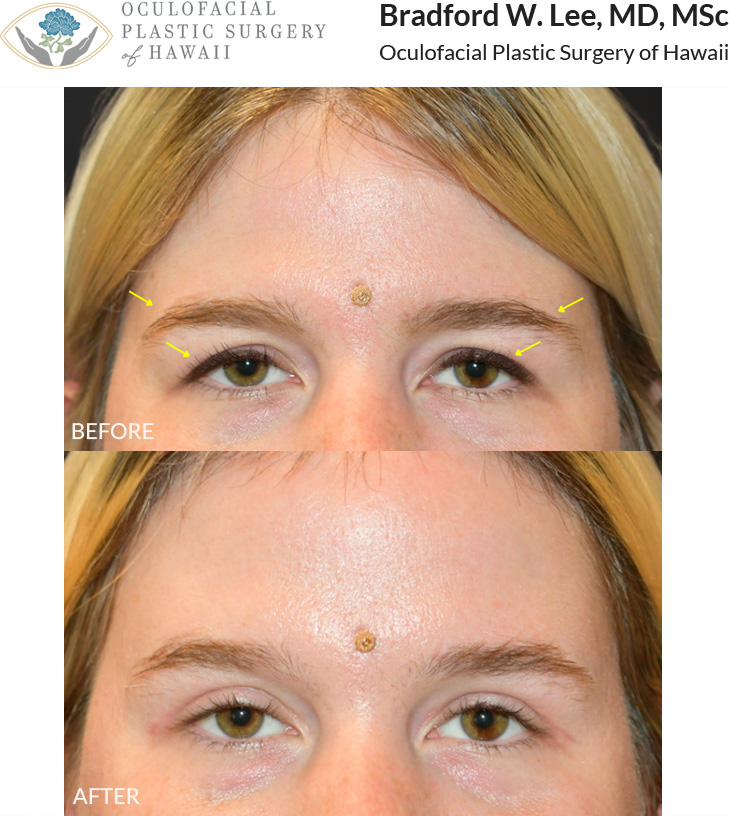 The patient in her 30s was bothered by the heaviness of her upper eyelids and brows and wanted a more lifted and 