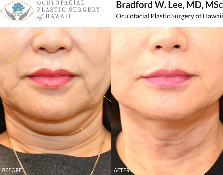 This patient in her 60s was bothered by gravitational changes and fullness in the jowl and neck regions. She underwent a face and neck lift to restore more youthful contours to the face and neck and enhance her jawline definition.