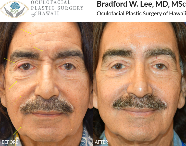 This patient in his 70s was bothered by drooping of the brows/forehead lines, excess skin on the upper lids and right lower lid, as well as gravitational changes and laxity in the face and neck. He underwent a brow and forehead lift with upper and right lower blepharoplasty along with a face and neck lift to give him a natural and refreshed appearance.