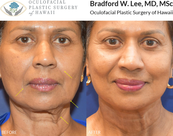 This patient in her 70s was bothered by jowling, gravitational changes and skin laxity to the face and neck. She underwent a face and neck lift, resulting in more youthful facial and neck contours.