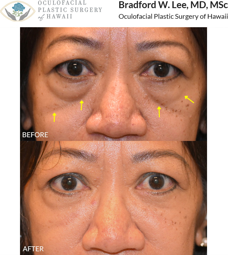 This patient in her 50s was bothered by the puffiness of her lower eyelids and hollowing/devolumization of her upper cheeks. She underwent a lower blepharoplasty to remove excess skin and fat with fat transfer to the superior cheeks, tear trough, and malar regions to restore lost volume to the midface and smoothen the lid-cheek junction.