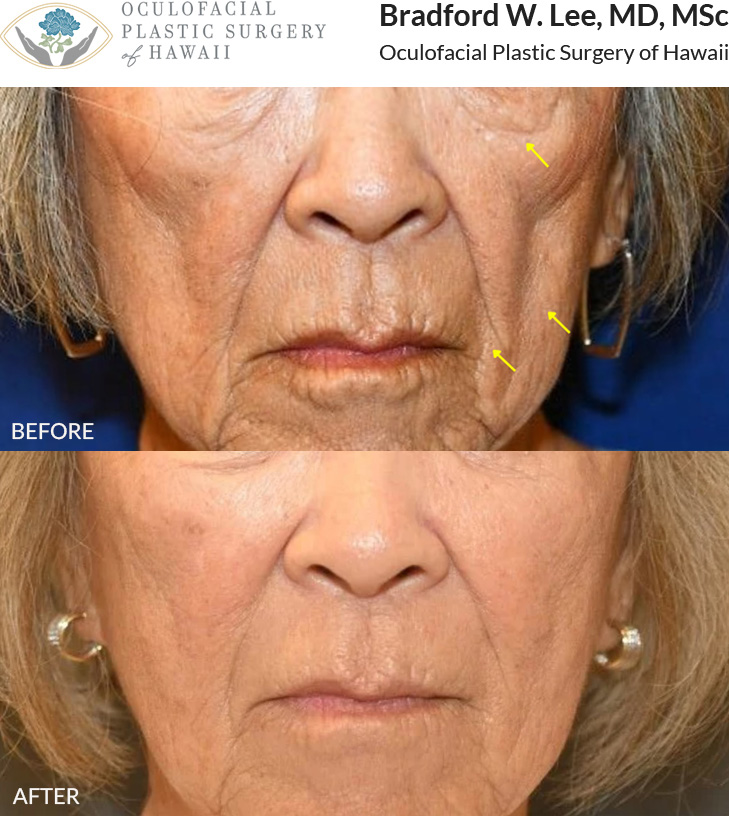 This patient in her early 80s was bothered by age-related volume loss in the under-eye, cheeks, and perioral region that she felt made her look gaunt and aged. She underwent fat transfer to the tear troughs, marionette lines, nasolabial folds, lips, and chin to revolumize these areas, improve skin quality, and have natural, durable results that do not require constant maintenance (like with fillers).