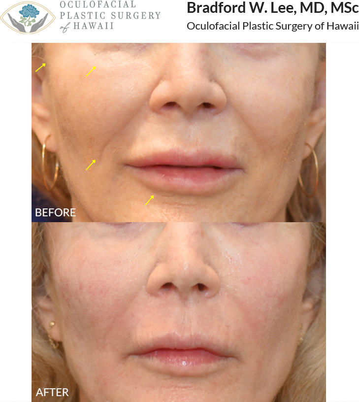 This patient in her early 70s was bothered by facial devolumization in the temples, under-eye region, cheeks, lips, and perioral region. She had prior fat transfer to the under-eye region and lip filler (done elsewhere) with some contour irregularities, and she also felt that her lip filler was starting to migrate and look unnatural. She underwent filler dissolution, CO2 laser resurfacing, and fat transfer to the lower lids and cheeks, nasolabial folds, temples, marionette region, and lips with nanofat injections to the radial lip lines, giving her a natural, refreshed, and rejuvenated look with beautiful, balanced facial volume and improved skin quality.