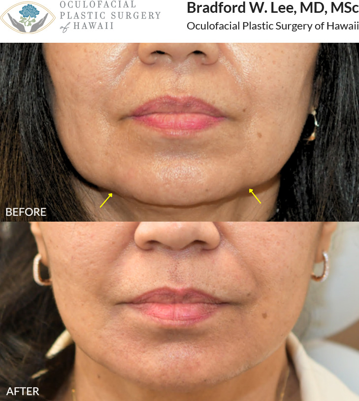 This patient in her 60s was bothered by the aging appearance of her upper and lower eyelids, as well as panfacial volume loss in the temples, cheeks, and perioral region. She underwent an upper and lower (quad) blepharoplasty to remove excess skin along with fat transfer to the temples, under eyes, upper cheeks, and perioral region to restore lost volume and a more youthful contour.