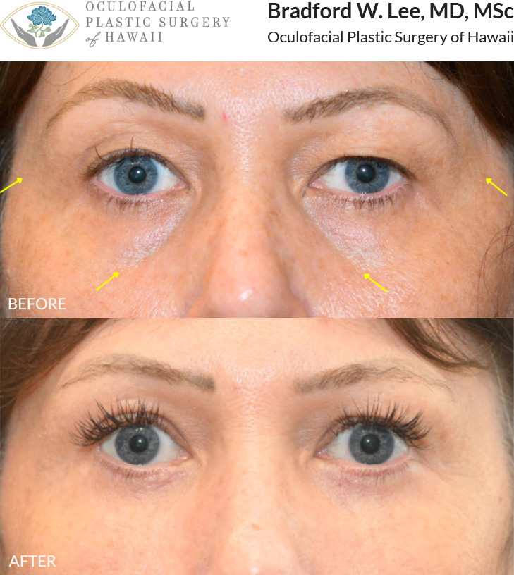 This patient in her 50s was bothered by hollowing of her temples and tear trough regions, mild left brow drooping, and excess skin on the upper eyelids. She underwent an upper blepharoplasty with a left internal brow lift, along with a lower blepharoplasty and fat transfer to the under eye region, upper cheeks, and temples to improve brow symmetry, enhance the eyes, and restore youthful facial contours, volume restoration, and a natural, refreshed look.