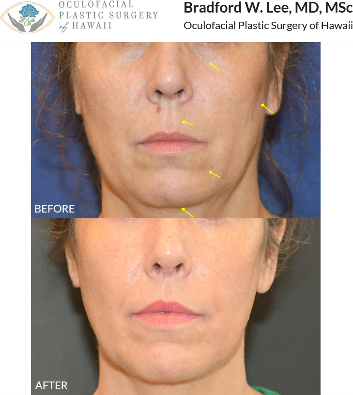 This patient in her 50s was bothered by vertical elongation of the upper lip as well as volume loss in the cheek, lips, and perioral region. She underwent a lip lift to shorten the upper lip, enhance the vermillion show and upper teeth show, and had fat transfer to the buccal fat region of the cheeks, perioral region, chin, and lips, resulting in a more youthful and naturally refreshed appearance.