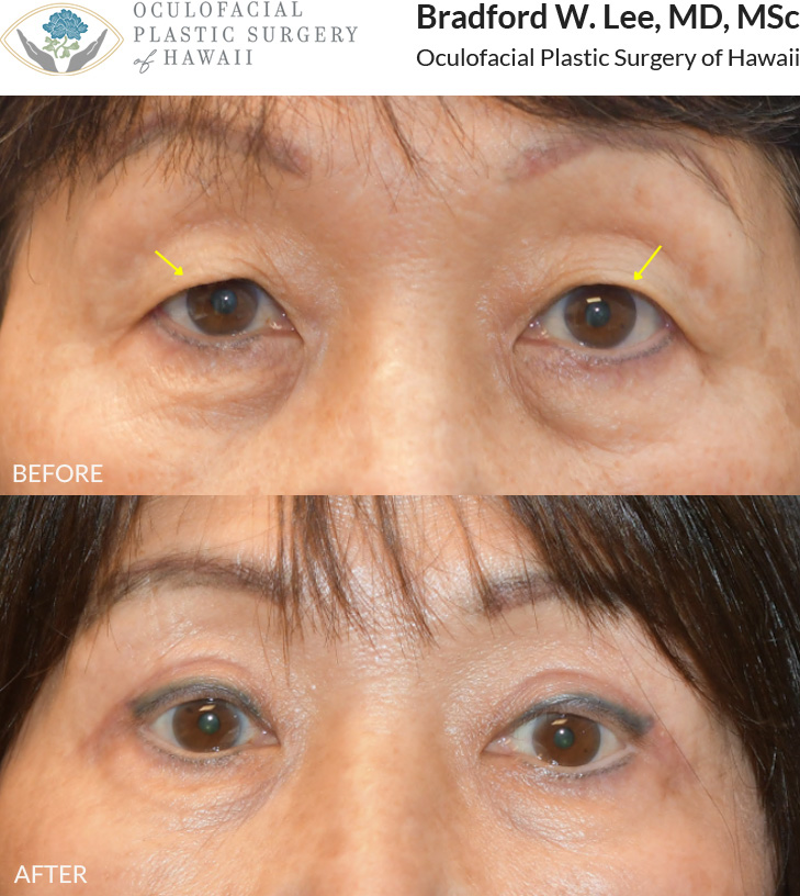 This 70+ year-old patient was bothered by heavy upper eyelids that were affecting her daily activities, including reading and driving. She underwent an Asian upper blepharoplasty to remove excess skin and fat and refine her natural eyelid crease.