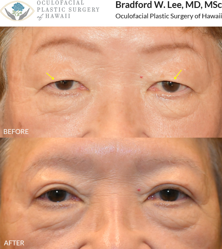 This 70+ year-old patient was bothered by drooping upper eyelids that were interfering with daily activities such as reading and driving. She underwent an upper blepharoplasty to remove excess skin, improving her vision while defining her eyelid crease.