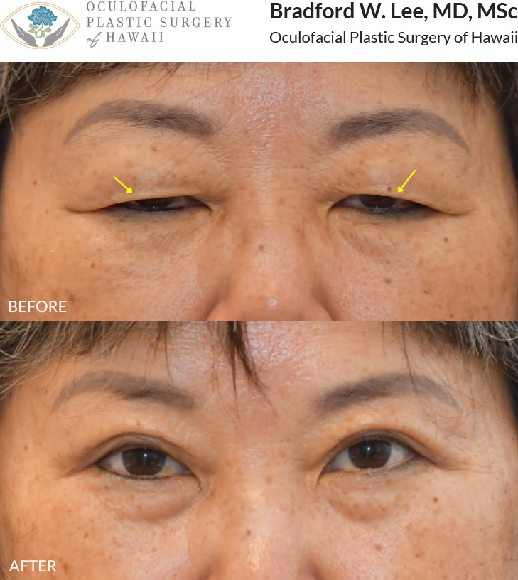 This 60+ year-old patient was bothered by heavy, drooping upper eyelids that were affecting daily activities such as reading and driving. She underwent an upper blepharoplasty to remove excess skin and fat from the upper eyelids, improving her vision while creating a more defined, natural-looking eyelid crease.