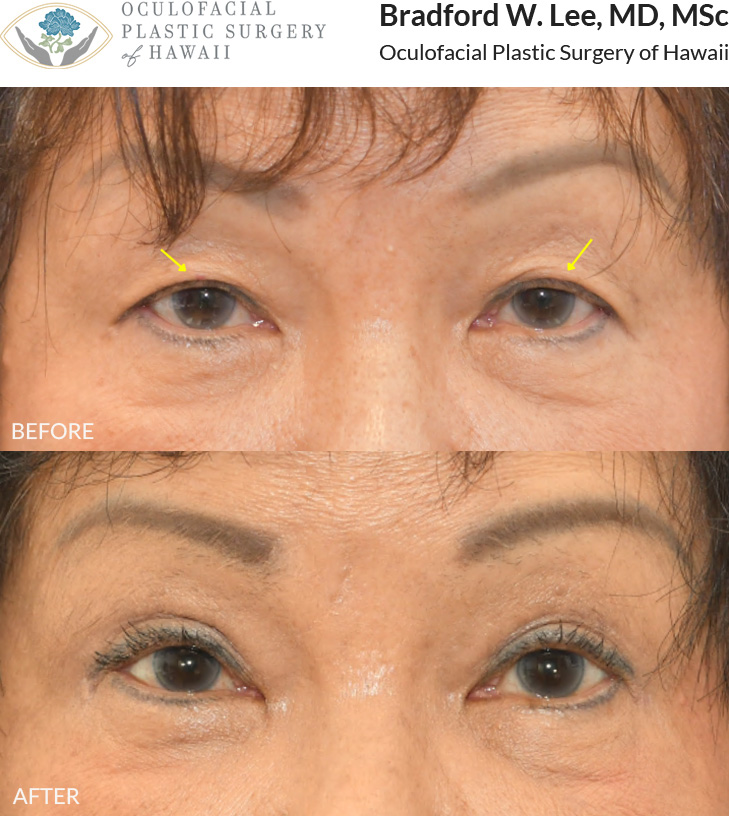 This patient in her 70s was bothered by heavy upper eyelids that were affecting daily actitivies such as reading and driving. She underwent an upper blepharoplasty to remove excess skin and define her eyelid crease.