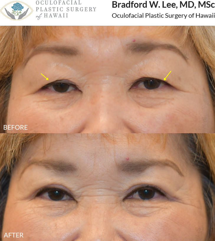 This 70+ year-old patient was bothered by heavy, drooping upper eyelids that made her appear tired and aged. She underwent an Asian upper blepharoplasty to remove the excess skin and fat weighing down her eyelids and refine her eyelid crease.