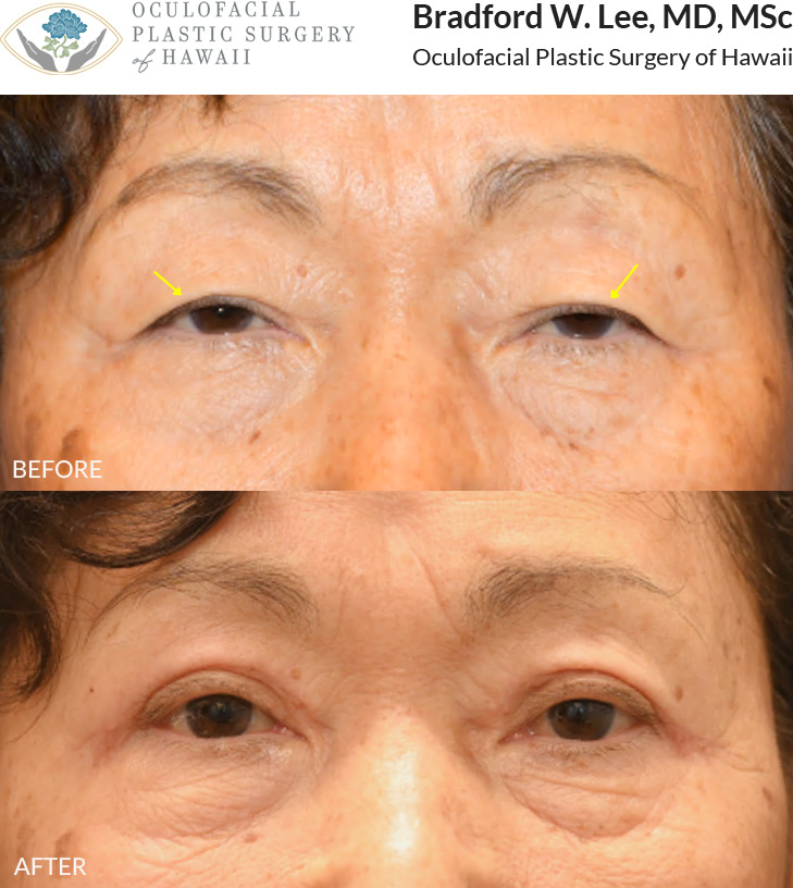 This 70+ year-old patient was bothered by drooping upper eyelids that were affecting her vision and required her to manually lift her eyelids to see better. She underwent an Asian upper blepharoplasty to remove the excess skin and fat weighing down her eyelids, improving her vision and refining her eyelid crease. **Residual post-op swelling will continue to resolve over the next few weeks