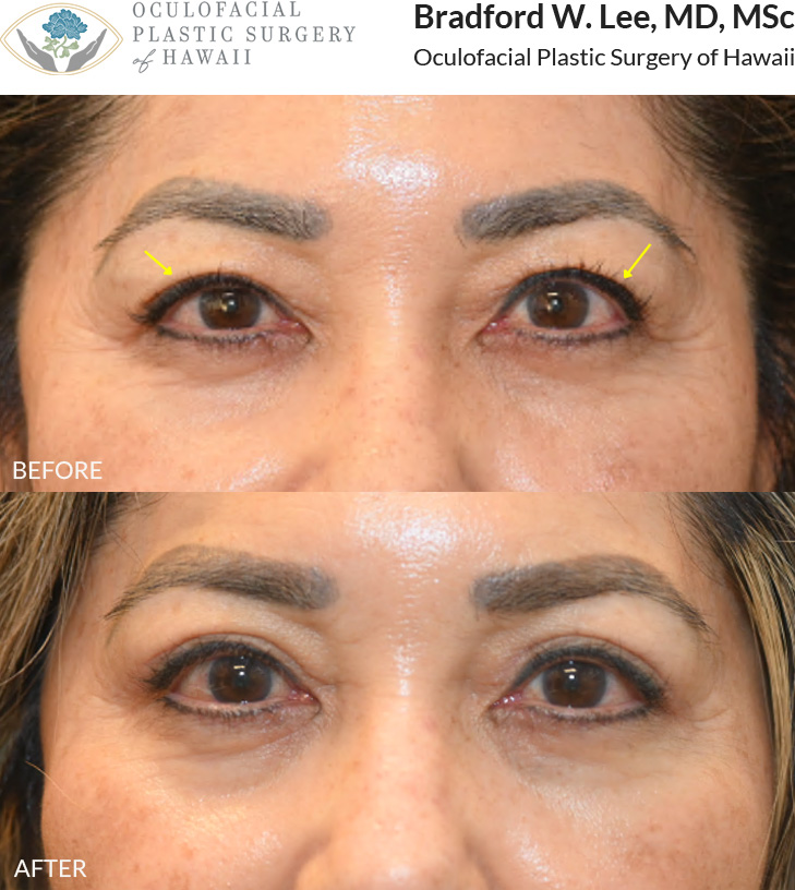 This 60+ year-old patient was bothered by drooping of her right upper eyelid and excess skin of the upper eyelids. She underwent an Asian upper blepharoplasty and right ptosis repair to improve eyelid symmetry and create a more even appearance.