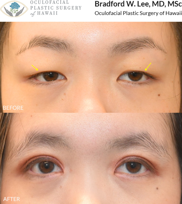 This 20+ year-old patient was looking to achieve a more defined double eyelid crease. She underwent an Asian upper blepharoplasty to create a natural-looking eyelid fold and enhance the appearance of her upper eyelids.