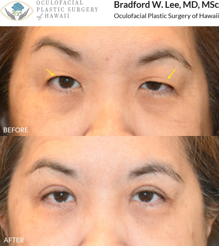 This 50+ year-old patient was bothered by heavy, drooping upper eyelids that were affecting her vision and daily activities such as reading, driving, and watching tv. She often found herself needing to lift her eyelids to see better. She underwent Asian an upper blepharoplasty to remove the excess skin weighing down her eyelids, improving her field of vision and defining her eyelid crease.