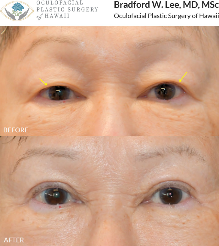 This 70+ year-old patient was bothered by drooping upper eyelids and desired a more defined, natural-looking eyelid crease. She underwent an upper blepharoplasty to remove excess skin and fat while creating a natural eyelid crease and enhancing the overall contour of her eyes.