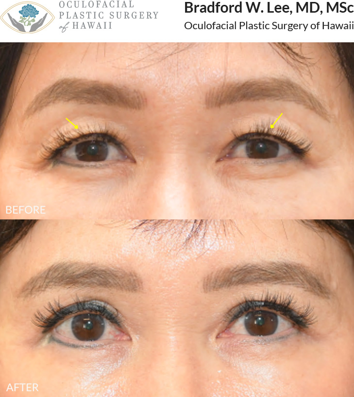 This 60+ year-old patient was bothered by drooping upper eyelids that were resting on her lashes and affecting daily activities such as reading and driving. She underwent an Asian upper blepharoplasty to remove excess skin and fat, improving her vision and refining her natural eyelid crease.