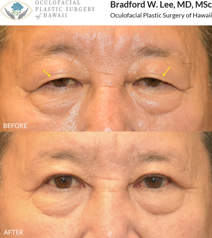 This 60+ year-old patient was bothered by drooping upper eyelids that were affecting his vision and contributing to a tired appearance. He underwent an upper blepharoplasty to remove excess skin and fat from the upper eyelids, improving his vision and defining his eyelid crease.