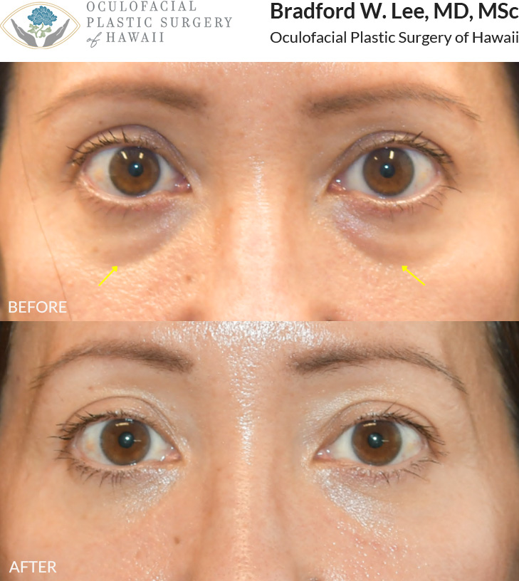 This 40+ year-old patient was bothered by the puffiness and hollowing under her eyes, which made her appear tired and aged. She underwent a lower blepharoplasty to remove excess skin and fat, creating a smoother, more refreshed, and rejuvenated under-eye appearance.