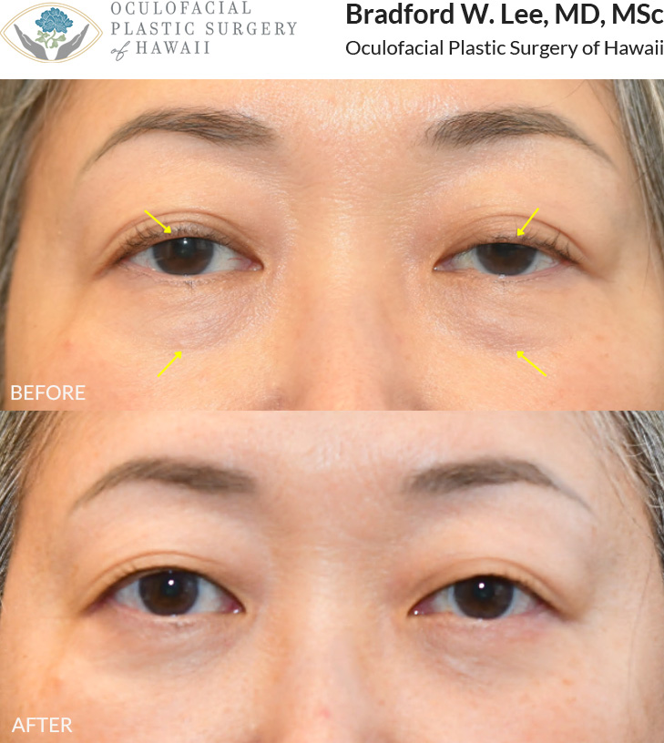 This 50+ year-old patient was bothered by puffy under-eye 
