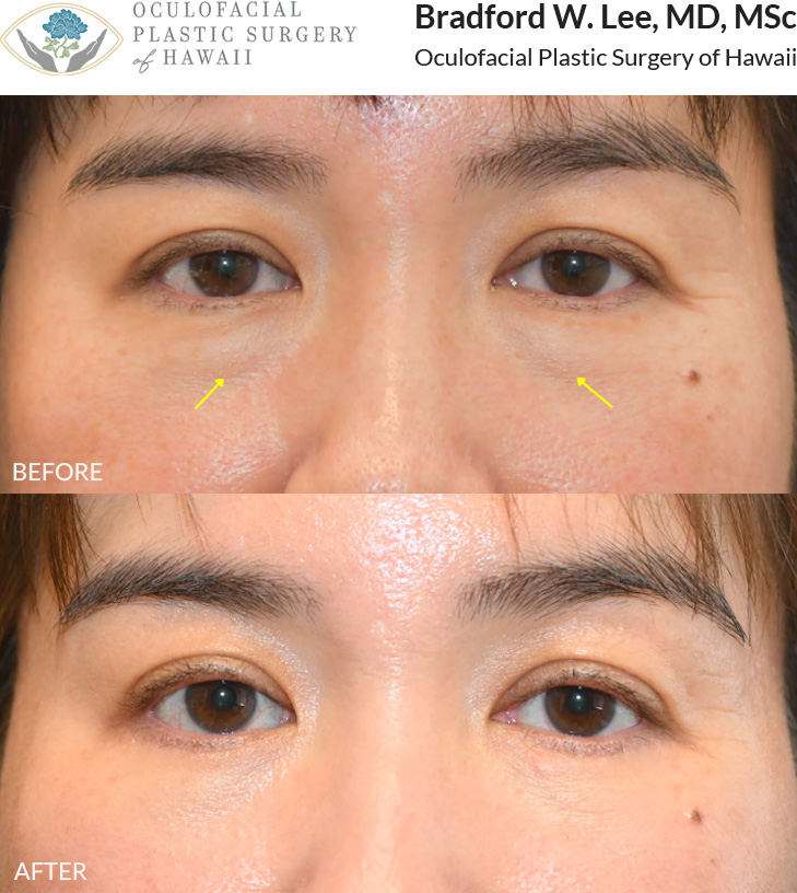 This 40+ year-old patient wanted to improve the fullness and shadowing beneath her eyes. She underwent a lower blepharoplasty to reduce under-eye puffiness and achieve a more refreshed, balanced appearance.