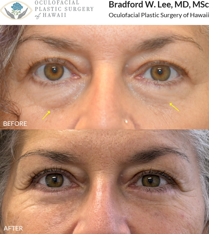 This patient in her 50s was bothered by prominent under-eye 