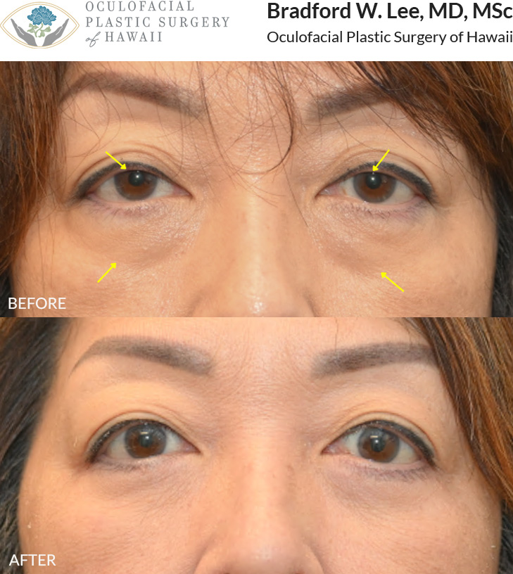 This patient in her 60s was bothered by the appearance of under-eye 