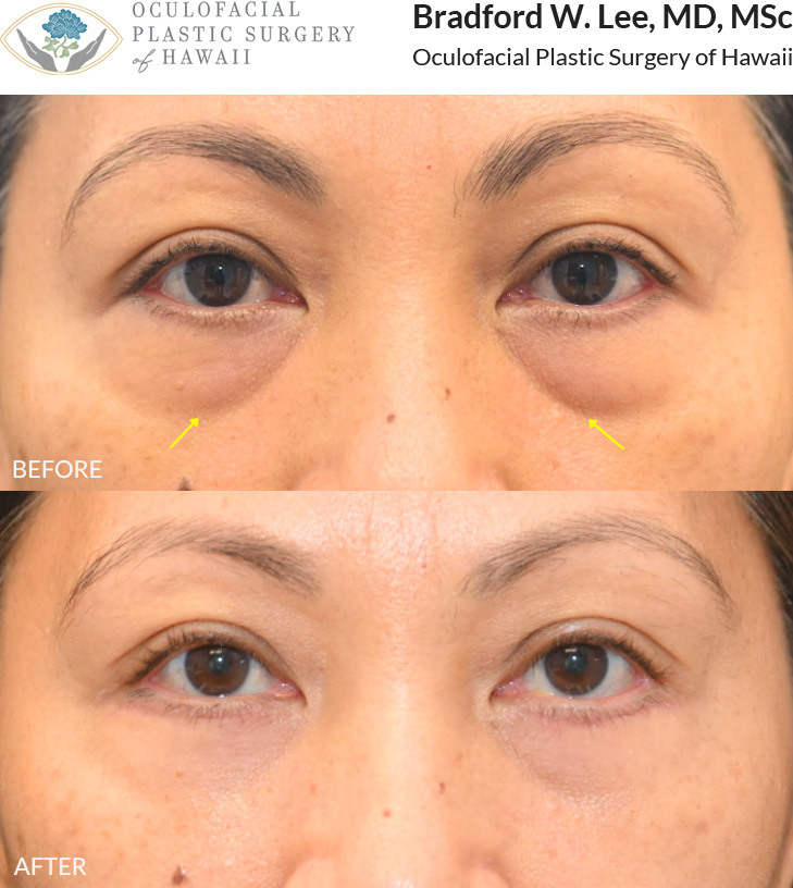 This 50+ year-old patient was bothered by puffy under-eye 