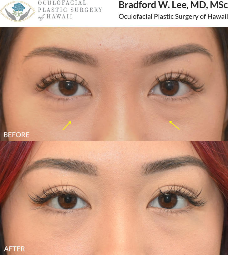 This patient in her 20s was bothered by under-eye puffiness. She underwent a lower blepharoplasty to refine the lower eyelid contour and create a smoother, more refreshed appearance.