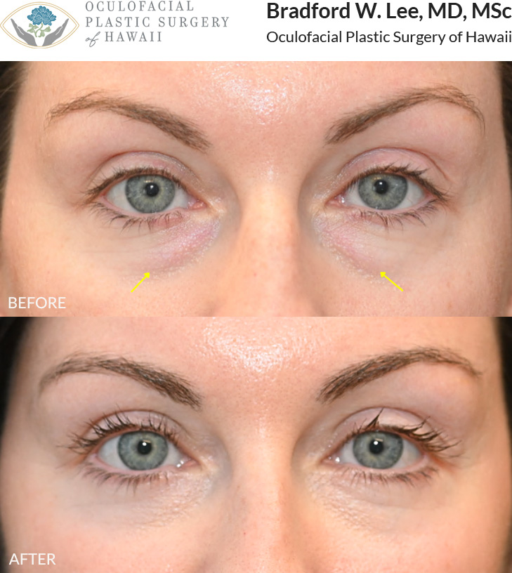 This patient in her mid to late 30s was bothered by the appearance of under-eye puffiness. She underwent a lower blepharoplasty to remove excess skin and fat, soften the under-eye contours, and restore a more youthful, refreshed appearance.