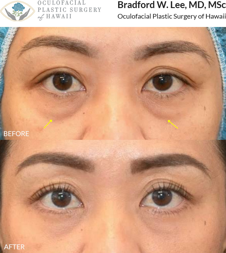This patient was bothered by the appearance of dark under-eye 