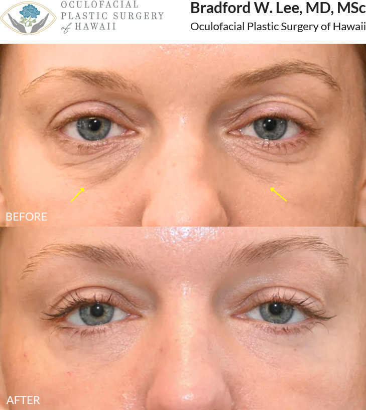 This 30+ year-old patient was bothered by under-eye puffiness and fine lines beneath her eyes. She underwent a lower blepharoplasty to remove excess skin and fat, along with UltraClear laser skin resurfacing to smooth fine lines and improve skin texture. This combination treatment created a smoother, more refreshed overall appearance.