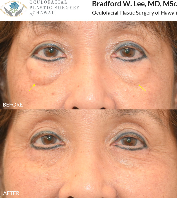 This patient in her 60s was bothered by the appearance of puffy under-eye bags. She underwent a lower blepharoplasty to remove excess skin and fat, restoring a softer under-eye contour and a naturally refreshed appearance.