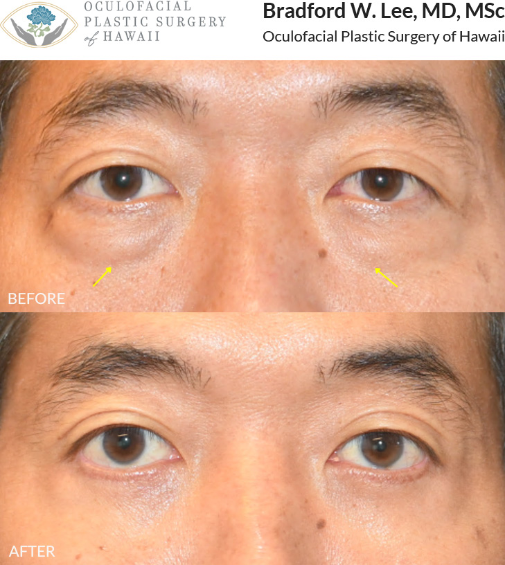 This 40+ year-old patient was bothered by the puffy appearance of his under-eye 