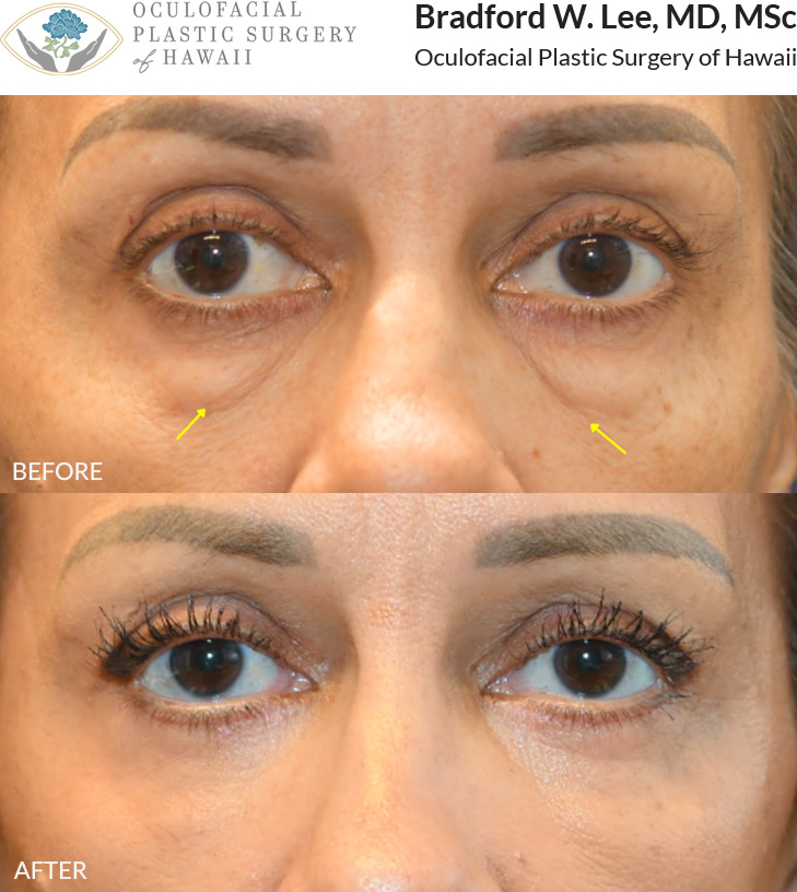This 50+ year-old patient was bothered by the fullness of her under-eye 
