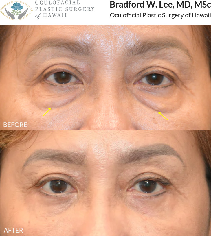 This patient in her 60s was bothered by the puffiness of her under-eye 