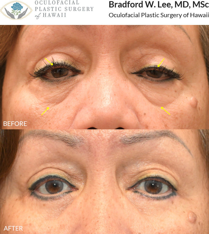 This patient in her mid to late 60s, was bothered by the puffiness of her undereyes as well as the drooping of her upper eyelids, which were affecting her vision. She underwent a lower blepharoplasty to remove and reposition excess fat in the undereye region, along with a ptosis repair to improve her vision and restore a more youthful eyelid contour.