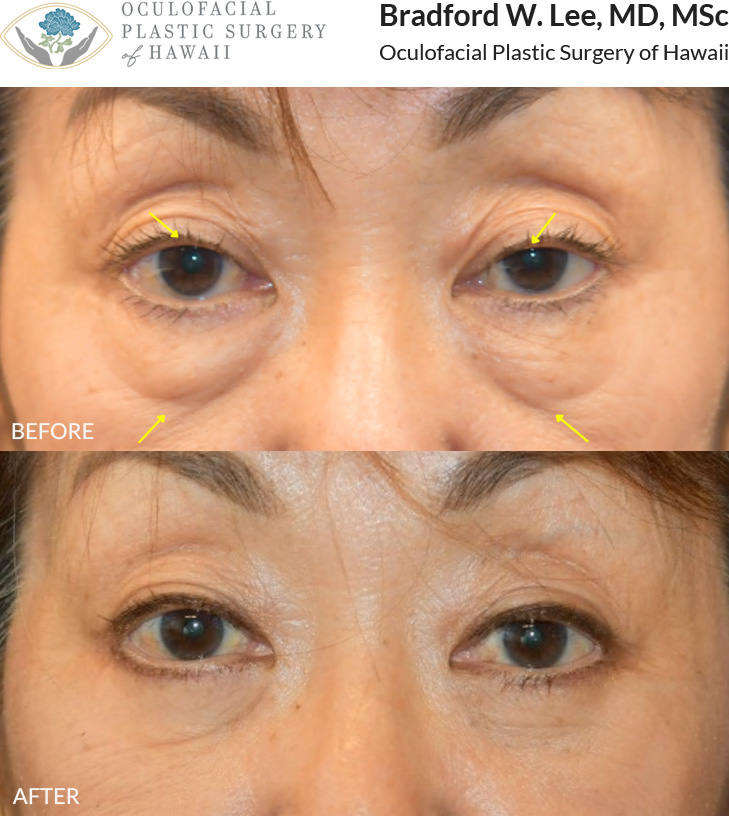 This patient in her mid to late 60s was bothered by the puffy appearance of her unde-reye 