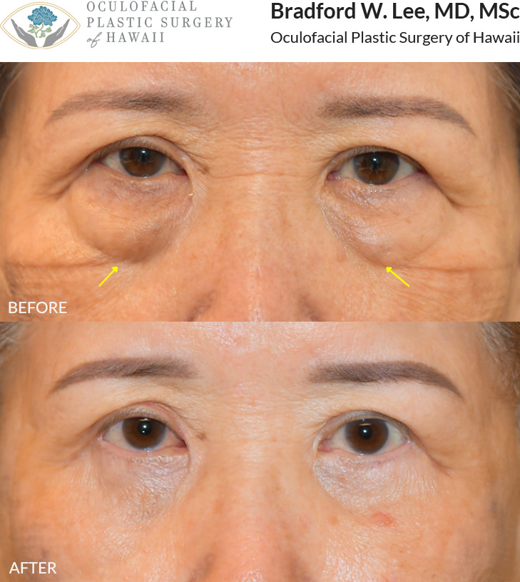 This 70+ year-old patient was bothered by the appearance of puffy under-eye 