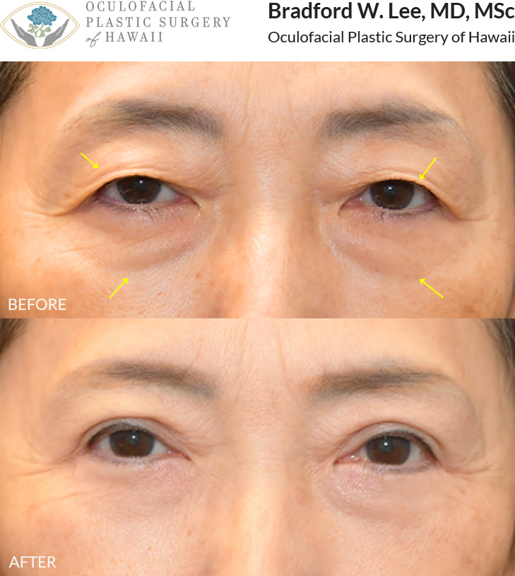 This 60+ year-old patient was bothered by excess skin on her upper eyelids which rested on her lashes, contributing to a tired, aged appearance. She was also bothered by the appearance of her under-eye “bags.” She underwent an upper and lower (quad) blepharoplasty to remove excess skin and fat from the upper eyelids and under-eye region, resulting in improved definition and reduced signs of aging.