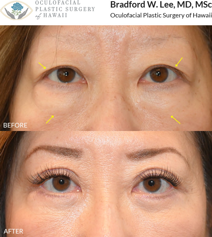 This 60+ year-old patient was bothered by upper eyelid hooding and puffiness under the eyes. She underwent an upper and lower (quad) blepharoplasty to remove excess skin and fat, defining her eyelid crease and smoothing out the under-eye region.