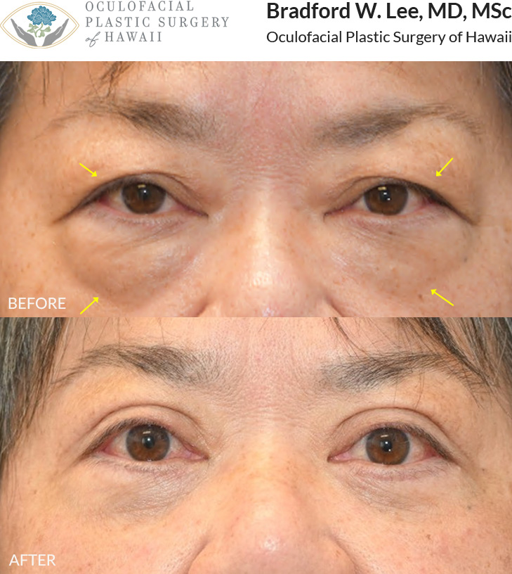 This patient in her mid to late 60s was bothered by the puffiness of her upper eyelids and under-eye “bags.” She underwent an upper and lower (quad) blepharoplasty to remove excess skin and fat, resulting in a smoother under-eye contour and a more youthful, refreshed appearance.