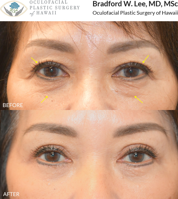 This patient in her 60s was bothered by excess skin of the upper eyelids and under-eye region, which contributed to a tired, aged appearance. She underwent an upper and lower (quad) blepharoplasty to address these concerns, resulting in a smooth under-eye contour and a more youthful, refreshed appearance.