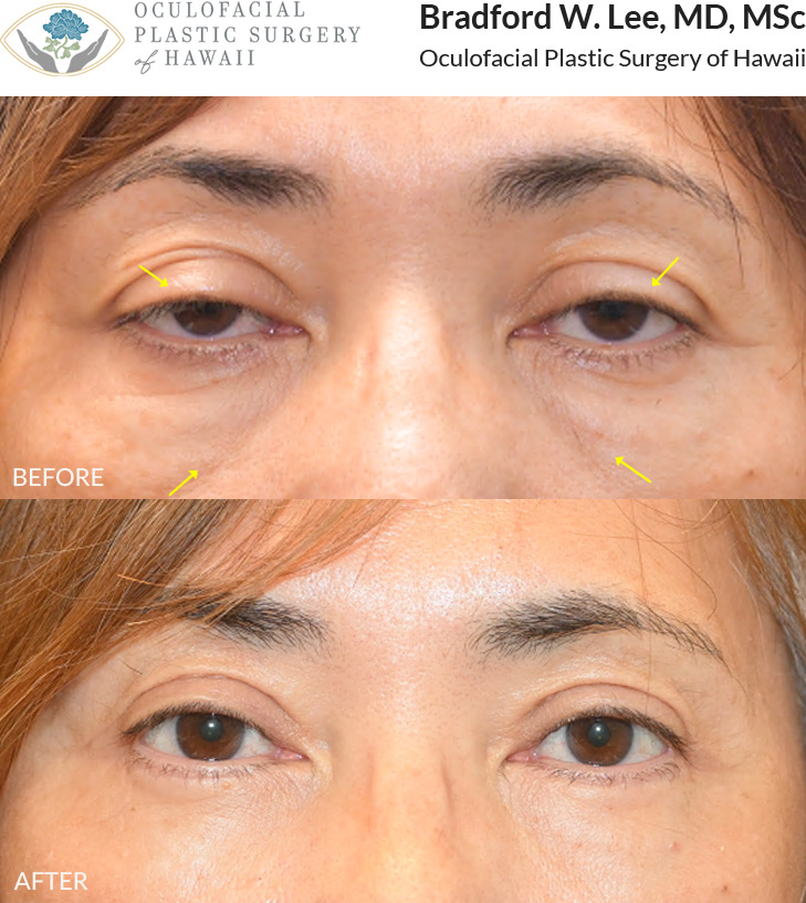 This 60+ year-old patient was bothered by drooping and heaviness of her upper eyelids, which affected her vision and interfered with daily activities. She was also interested in improving the appearance of her under-eyes. She underwent an upper and lower (quad) blepharoplasty with ptosis repair to remove excess upper eyelid skin and enhance her vision, while smoothing and rejuvenating her under-eyes.
