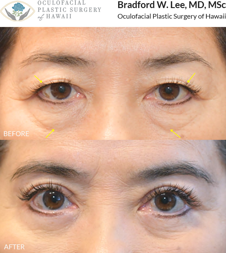 This patient in her 60s was bothered by drooping upper eyelids that rested on her lashes and by the appearance of under-eye “bags.” She underwent an upper and lower (quad) blepharoplasty to remove excess skin and fat from both the upper and lower eyelids, enhancing her eyelid crease and natural contours.