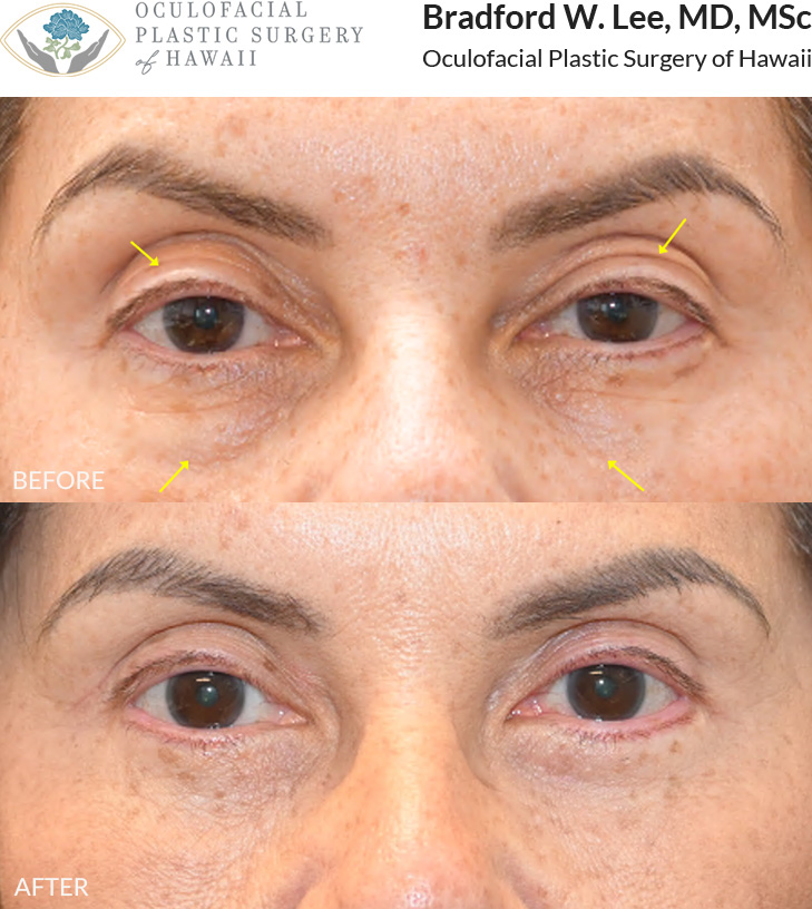 This patient iin her 60s was bothered by asymmetry of her upper eyelids and the appearance of multiple eyelid creases. She was also concerned about hollowing under her eyes, which contributed to a tired appearance. She underwent an upper and lower (quad) blepharoplasty to address these concerns, resulting in a natural and balanced rejuvenation.